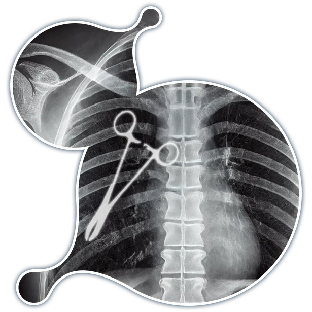 Instrument left in the lungs after operations - Examining Board QA QI Technology Integration